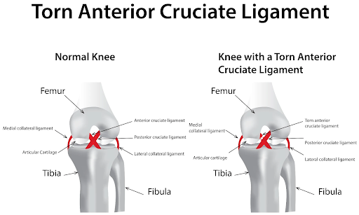 ACL Injuries